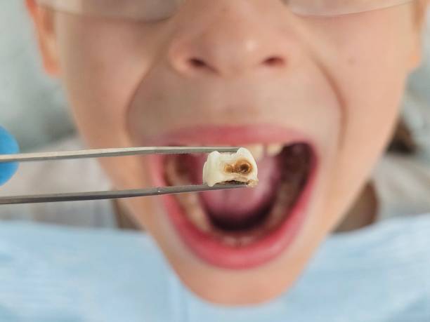 Best Emergency Broken Tooth Repair in Shongopovi, AZ